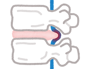ヘルニアのイラスト