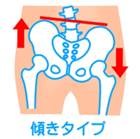 骨盤傾きタイプ